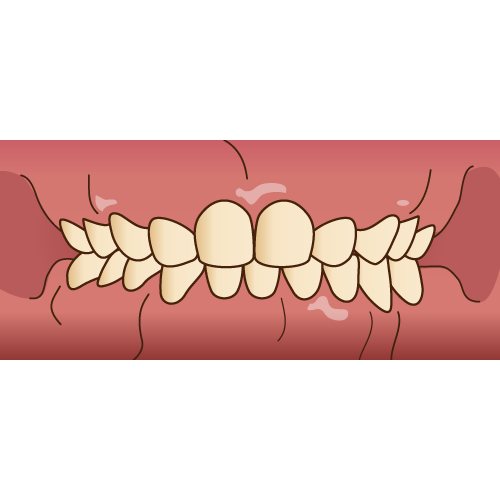 歯ぎしりのない乳歯の歯並び