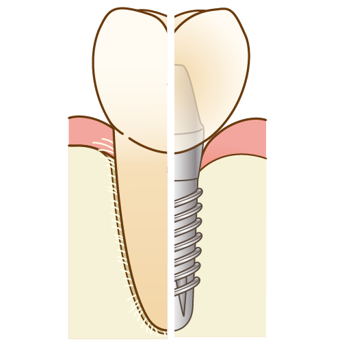 インプラントと天然歯