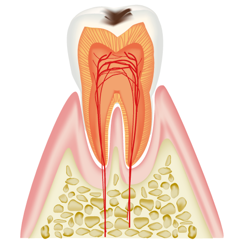 歯の断面（Ｃ１）
