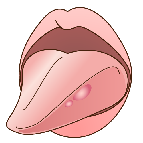 舌の裏側の口内炎（こうないえん）