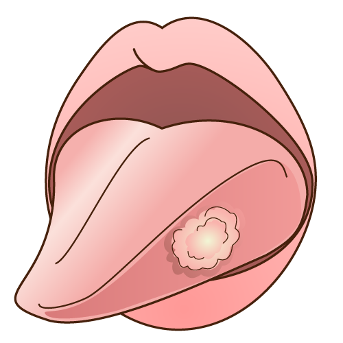 白い舌癌（ぜつがん）