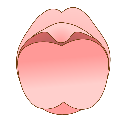 舌小帯が短い場合の舌の形
