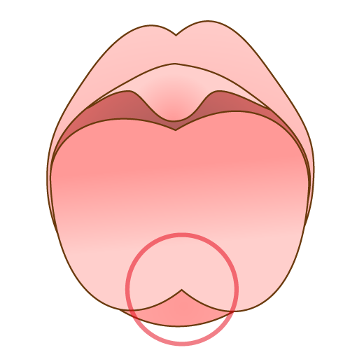 舌小帯が短い場合の舌の形 目印