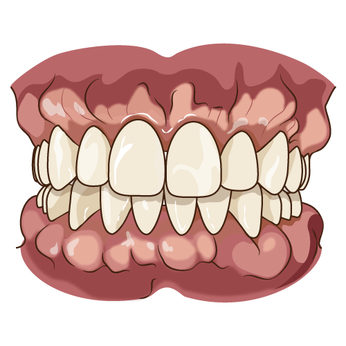 骨隆起：歯槽隆起の比較