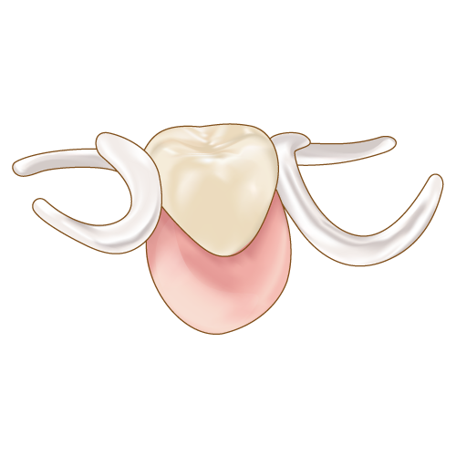 白いバネの部分入れ歯
