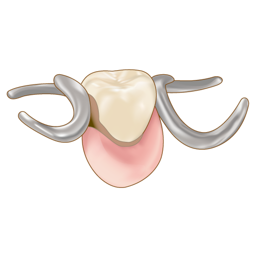 汚れてきた部分入れ歯