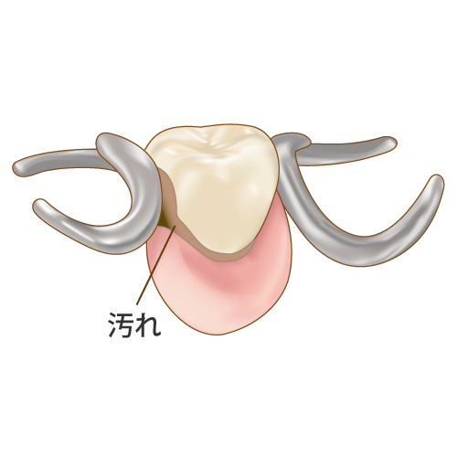 汚れてきた部分入れ歯、キャプション付
