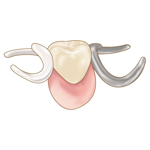 銀と白のバネを比較した部分入れ歯 歯科素材 Com 歯医者さん向け無料イラスト