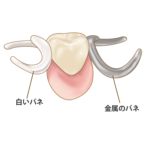 銀と白のバネを比較した部分入れ歯（キャプション付）