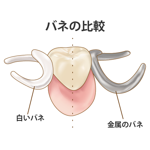 銀と白のバネを比較した部分入れ歯（点線、タイトル、キャプション付）