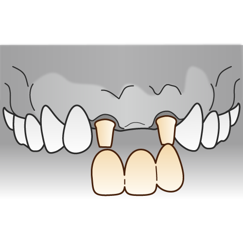 ブリッジの手順4 5 モノクロ 歯科素材 Com 歯医者さん向け無料イラスト