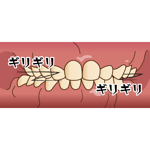 歯ぎしり イラスト一覧 歯科素材 Com 歯医者さん向け無料イラスト