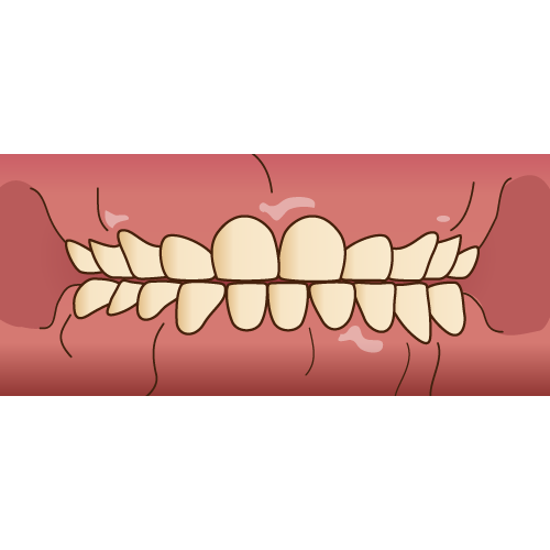 切端咬合の乳歯
