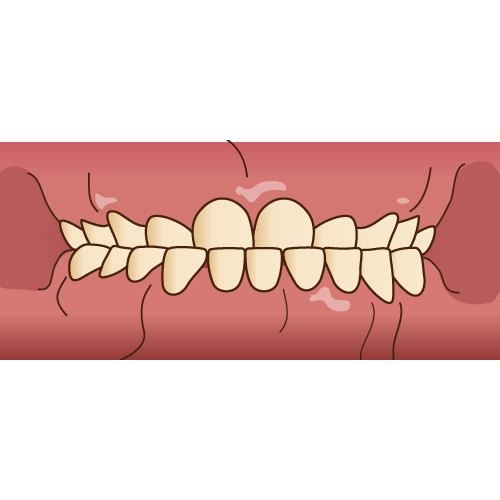 下顎前突の乳歯