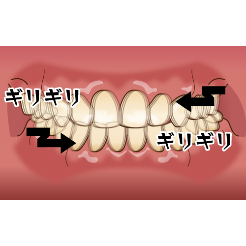 上下の歯のすり合わせ（効果音、矢印付き）