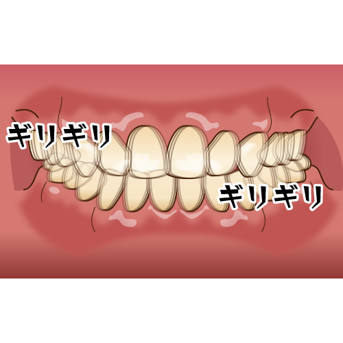 ギリギリと歯ぎしりをする歯