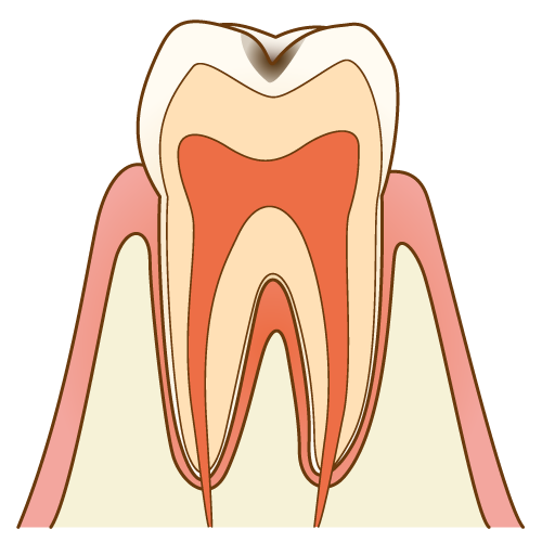 むし歯（C1）