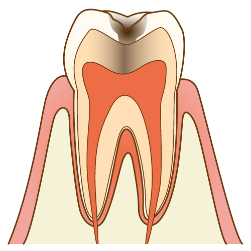 むし歯（C2）