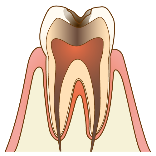 むし歯（C3）