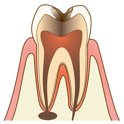 むし歯（C3）