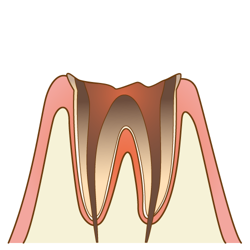 むし歯（C4）