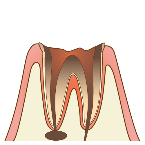 むし歯（C4）