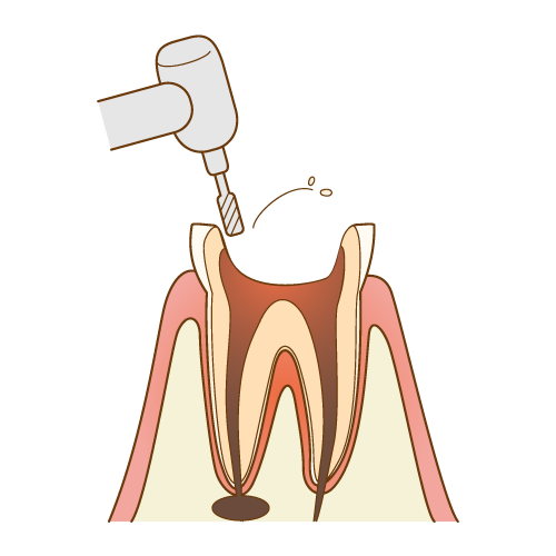 歯根の治療手順3/7