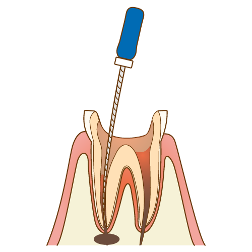 歯根の治療手順4/7