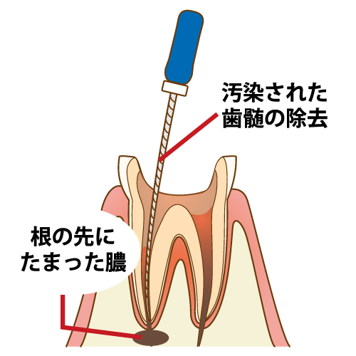 歯根の治療手順4/7（キャプション付き）