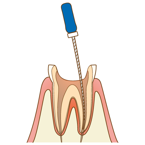 歯根の治療手順5/7
