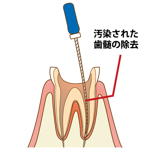 歯根の治療手順5/7（キャプション付き）
