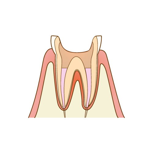 歯根の治療手順6/7