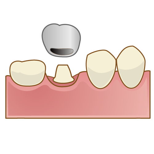銀歯の被せ物