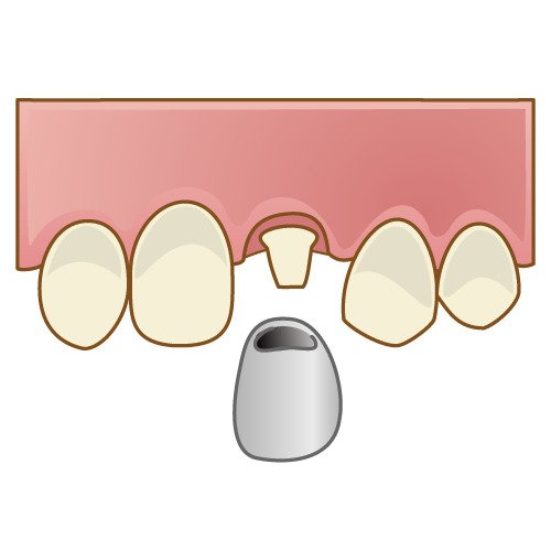 銀歯の被せ物（上の歯）