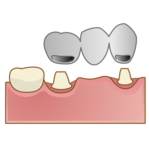 銀歯のブリッジ