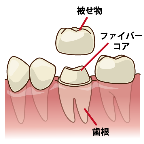 ファイバーコア（臼歯/キャプション有）