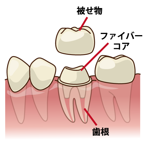 ファイバーコア（臼歯・透過/キャプション有）