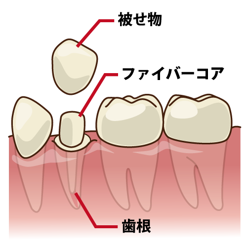 詰め物 被せ物 イラスト一覧 歯科素材 Com 歯医者さん向け無料イラスト