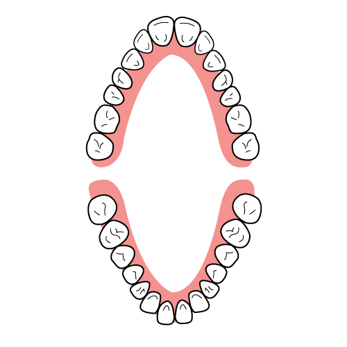 歯列弓の形（発育不全のV字型）