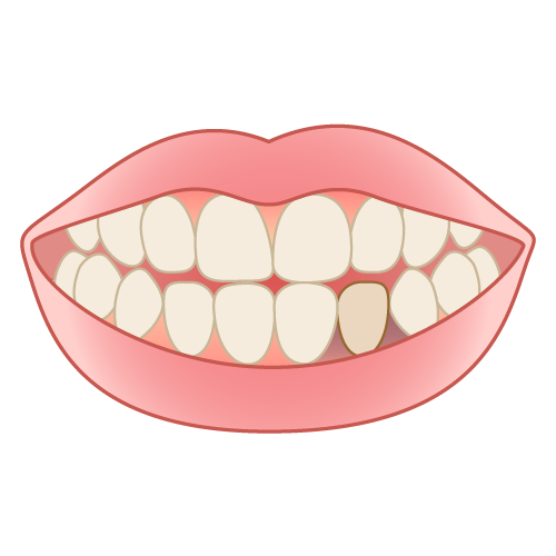 部分的な歯と歯ぐきの変色