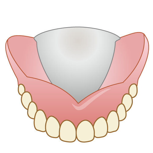 前方からみた金属床の総入れ歯