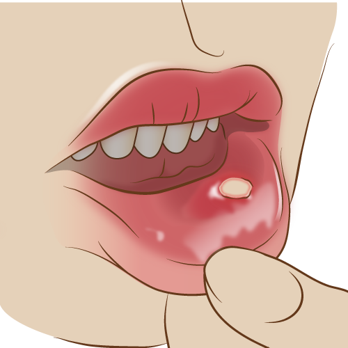 下唇の口内炎