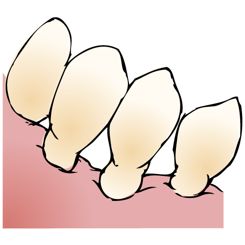 歯根の露出 イラスト一覧 歯科素材 Com 歯医者さん向け無料イラスト