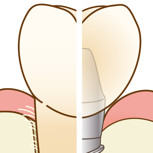 インプラントと天然歯（拡大）