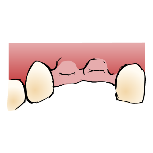 インプラント手順1/6