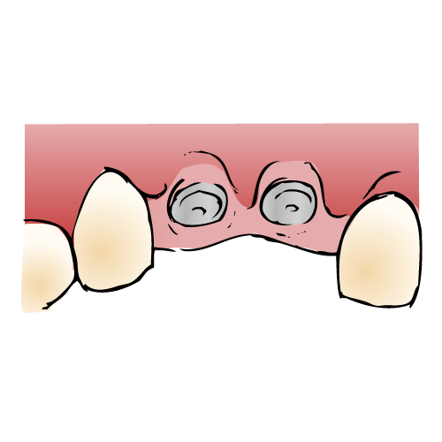 インプラント手順2/6