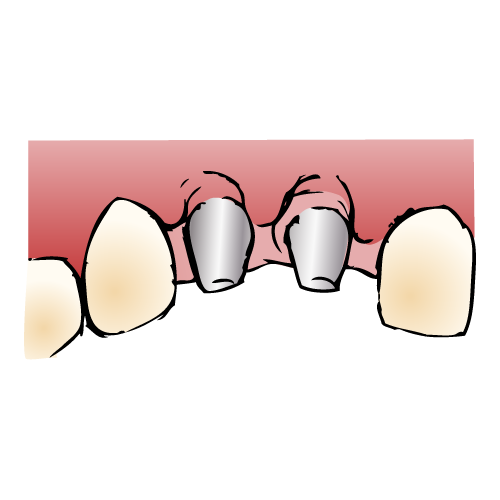 インプラント手順4/6