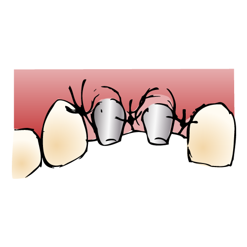 インプラント手順5/6