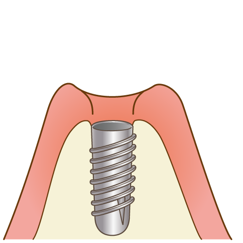 インプラント埋入（手順3/6）