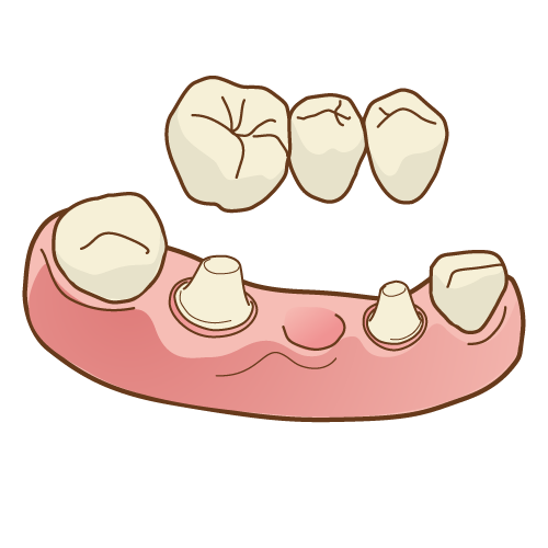 詰め物被せ物 比較（ブリッジ）